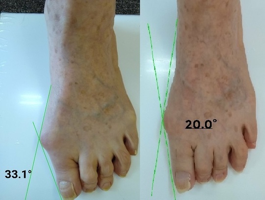 上尾市で外反母趾の治療でお悩みなら あゆみ整骨院 整体院へ 上尾市の腰痛 足のト 膝痛ラブル あゆみ整骨院 整体院